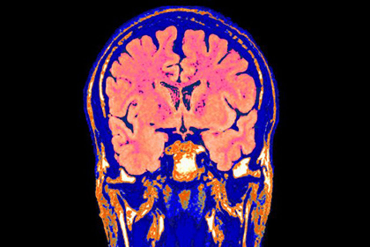 Технологию оживления мёртвого мозга разрабатывает американская компания Bioquark. Вскоре учёные приступят к клиническим испытаниями