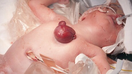 СМИ: британские кардиологи спасли младенца, родившегося с сердцем вне грудины