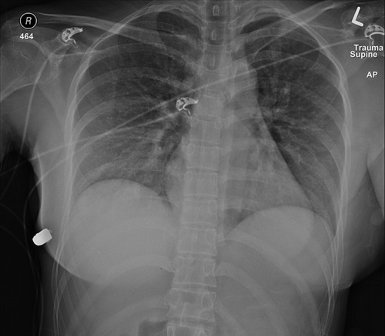 силиконовая грудь на рентгене фото 2