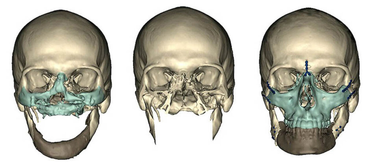 Кт лицевых костей. Перелом костей лицевого черепа кт. Череп перелом скуловой кости. Повреждение костей лица. Перелом лицевой части черепа.