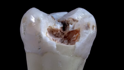 Стоматологи сломали челюсть уральской пенсионерке
