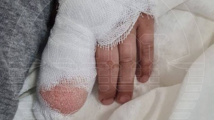 Врачи пришили оторванные пальцы ребенку в Санкт-Петербурге
