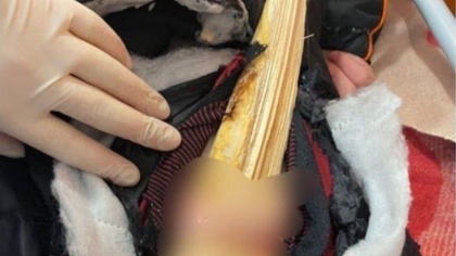 Гигантская заноза проткнула ягодицу школьника после игр на горке в Карпинске